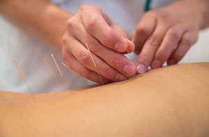 Acupuncture Aylesbury Buckinghamshire